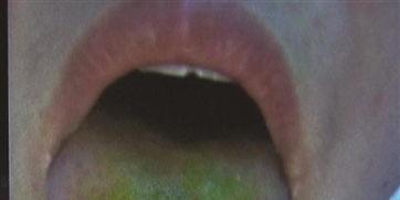 吃瓜后舌头难受,揭秘夏日消暑美食的副作用  第1张