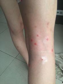 吃瓜过敏起红点  第2张